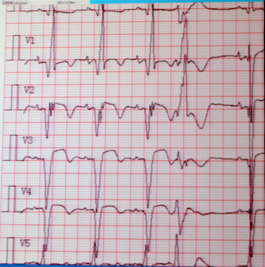 [CHRS2017]钟杭美:急性心梗合并传导阻滞的心