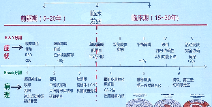 [渤海2017]肖卫忠:帕金森病的诊断及治疗_肖卫