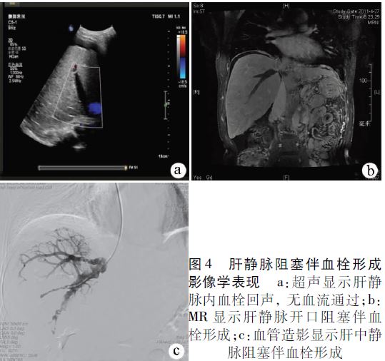 超声检查可见阻塞的肝静脉管腔内血栓回声,无血流回声(图4a)