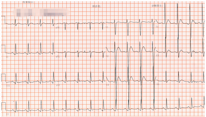 高钙血症心电图