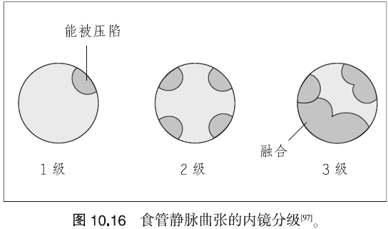 图文并茂 | 一起了解门脉高压的临床表现