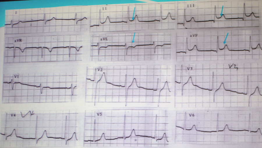 [CHRS2017]张海澄:牢记这6种心电图表现,还怕