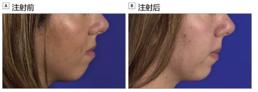 a型肉毒毒素注射改善颏部轮廓