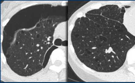肺部HRCT基本征象丨低密度型_肺HRCT基本征