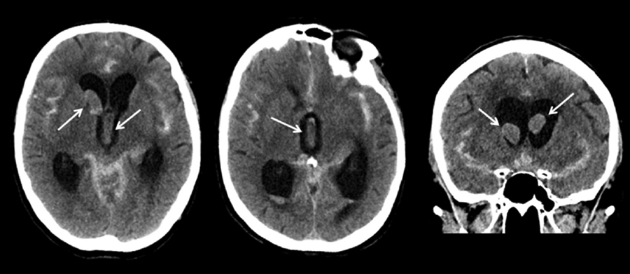一例蛛网膜下腔出血患者的头CT,你能读出哪些