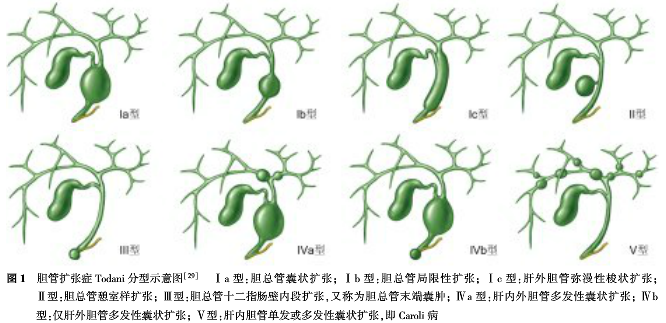 分为3个亚型:ia型:胆总管囊状扩张;ib型:胆总管局限性扩张;ic型:肝外