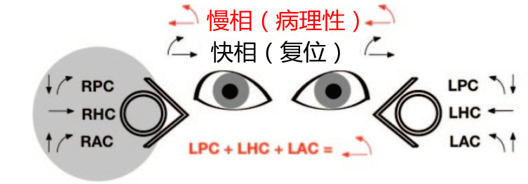 功能障碍时,相当于右侧半规管激活,双眼球将缓慢向左转动(眼震慢相)