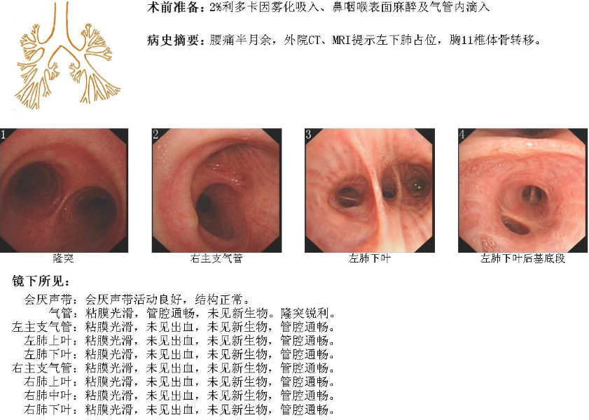 肺癌+骨转移OR肺结核+骨结核?_肺结核_骨结核