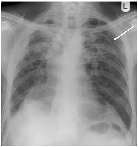 这是一名长期纤维化肺部疾病患者的胸片,此人出现左肺尖部气胸(箭头