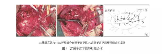 宫颈子宫下段环形缝合术在前置胎盘剖宫产术中出血的临床应用