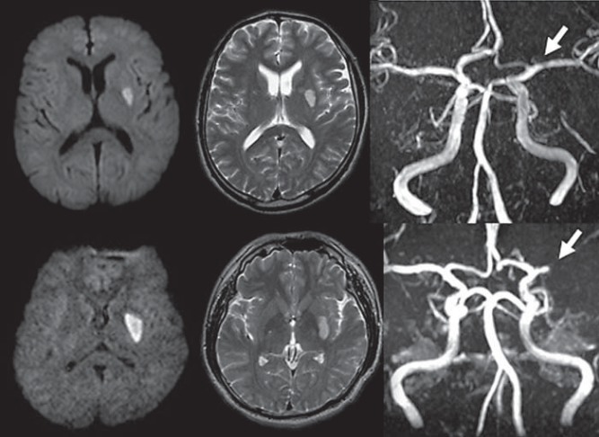 “腔隙性脑梗死”这个临床诊断，可以慢慢作古了_腔隙性脑梗死_缺血性脑卒中_医脉通