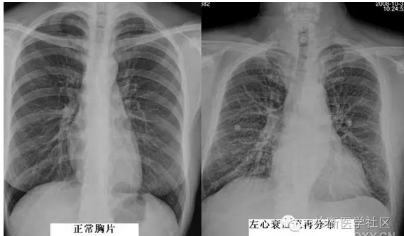 表现为肺纹理增根,增多,边缘模糊,以两上肺野明显,肺野透过度减低