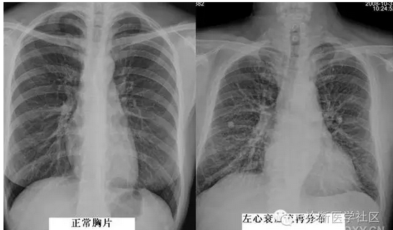 3分钟读懂胸片上肺纹理的改变,建议收藏!