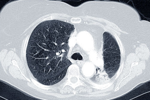5个经典病例,读懂肺癌诊断_肺癌_胸部影像学