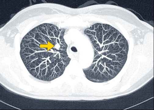 5个经典病例,读懂肺癌诊断_肺癌_胸部影像学