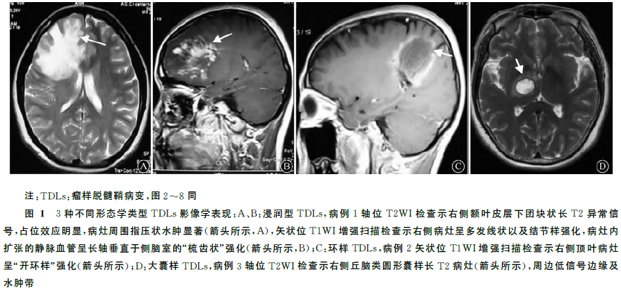 最新中枢神经系统瘤样脱髓鞘病变诊疗指南发布