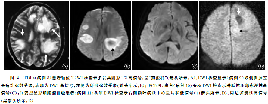 最新中枢神经系统瘤样脱髓鞘病变诊疗指南发布