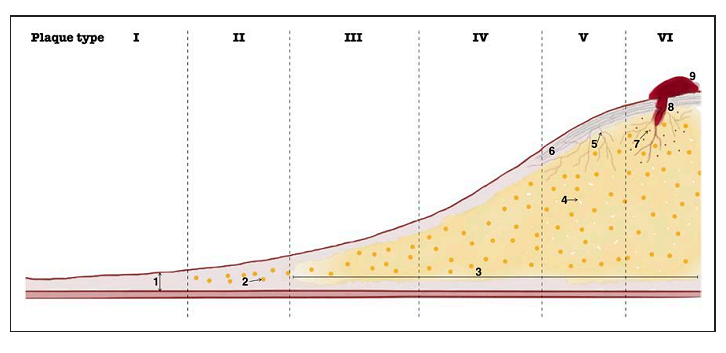 颈动脉狭窄斑块长什么样,卒中复发风险会更高