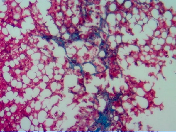 NEJM:非酒精性脂肪性肝炎是怎么形成的?如何管理?_NEJM_非酒精性脂肪性肝炎_管理_医脉通