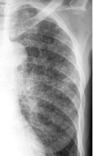原发性肺结核的4种胸片特征_原发性肺结核_继