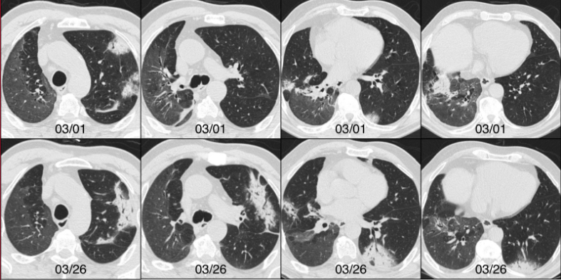 盘点丨炎症性肺病中肺实变的影像特征