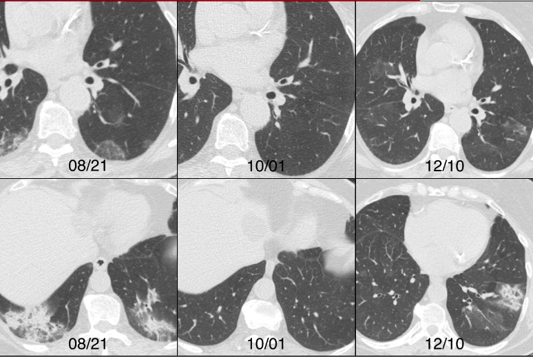 盘点丨炎症性肺病中肺实变的影像特征