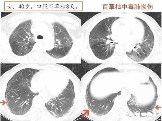 HRCT肺胸膜下线的表现及意义