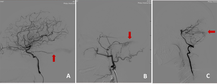 多看多思,练就火眼金睛,绝不放过硬脑膜动静脉