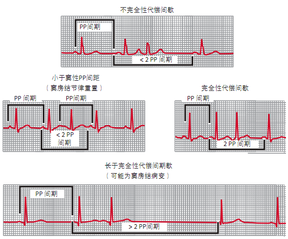 心律失常:心电图分析的两个关键步骤