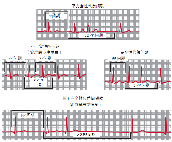 每隔一个qrs波群就存在一个期前收缩叫作房性二联心律;每三个qrs波群