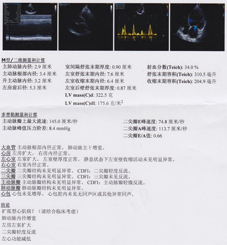 超声心动提示左室扩大,舒张末期内径76 mm,ef 34%
