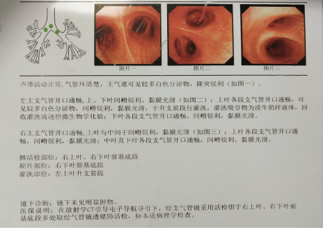 支气管镜检查如下