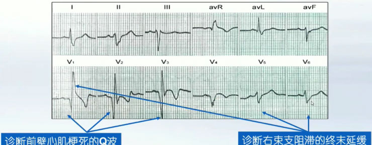 急性心梗6种不典型心电图:不可忽视的改变