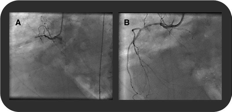 急性前壁心梗?NO!谁来拯救我的心电图