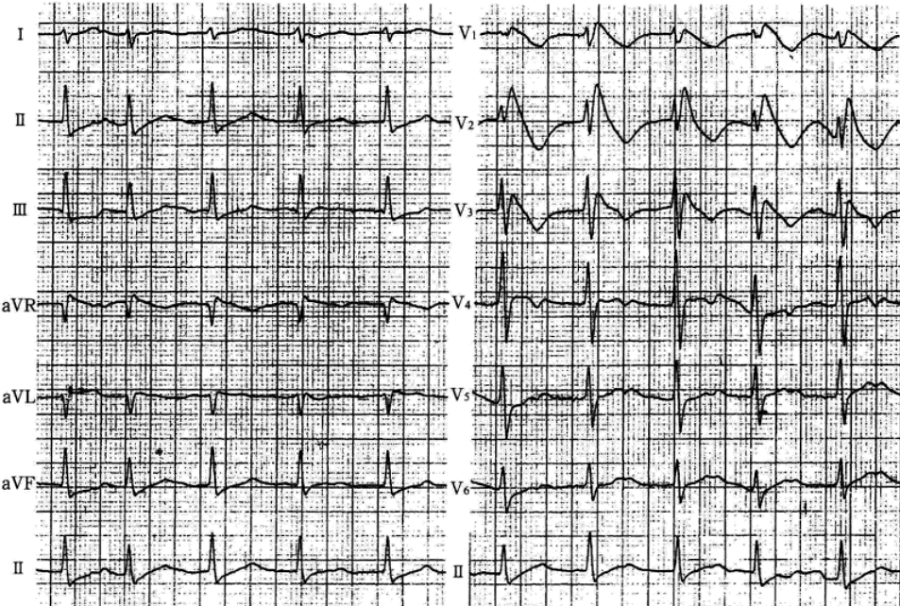 这些少见的心电图异常波,你听说过吗?