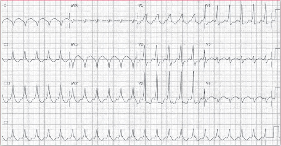 四个病例带你吃透预激综合征心电图