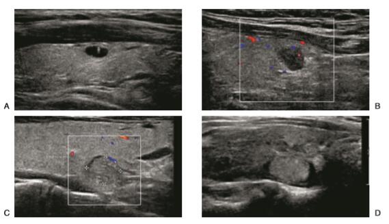 图文理清:甲状腺结节的超声诊断