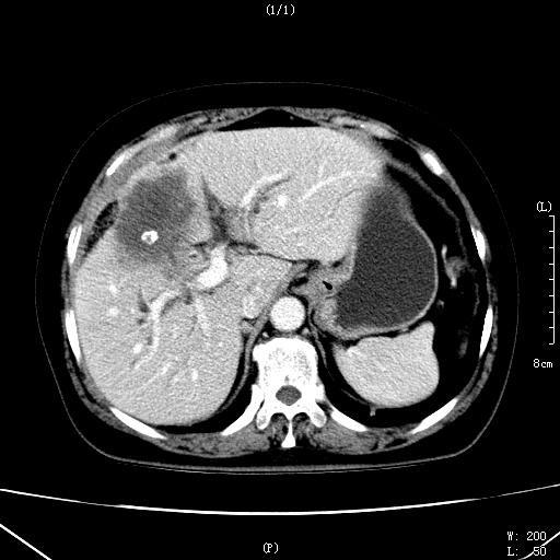 全身乏力半年,食纳逐渐减少,首先想到什么病?