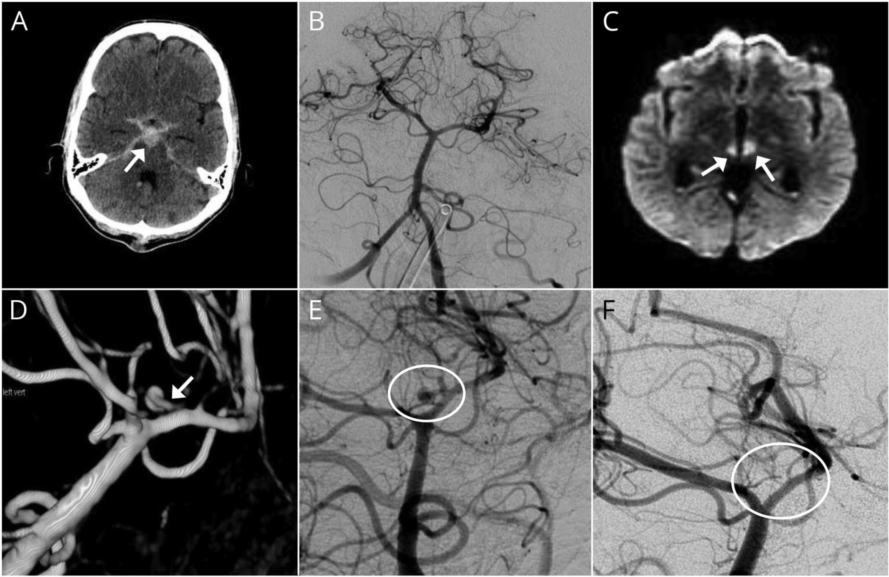 什么是动脉瘤性蛛网膜下腔出血 15296383498915.png