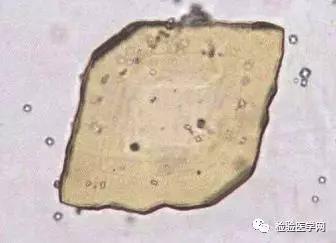 尿液里有结晶,究竟有何临床意义?