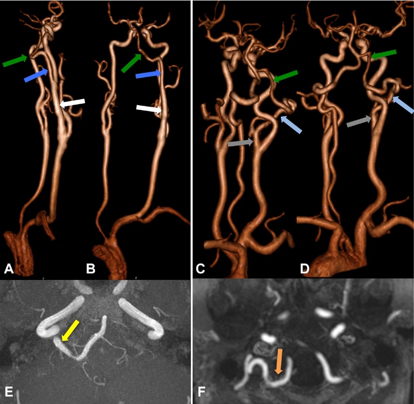 a,b和e图显示永存原始舌下动脉(ppha):容积渲染3d对比增强mra斜位(a)