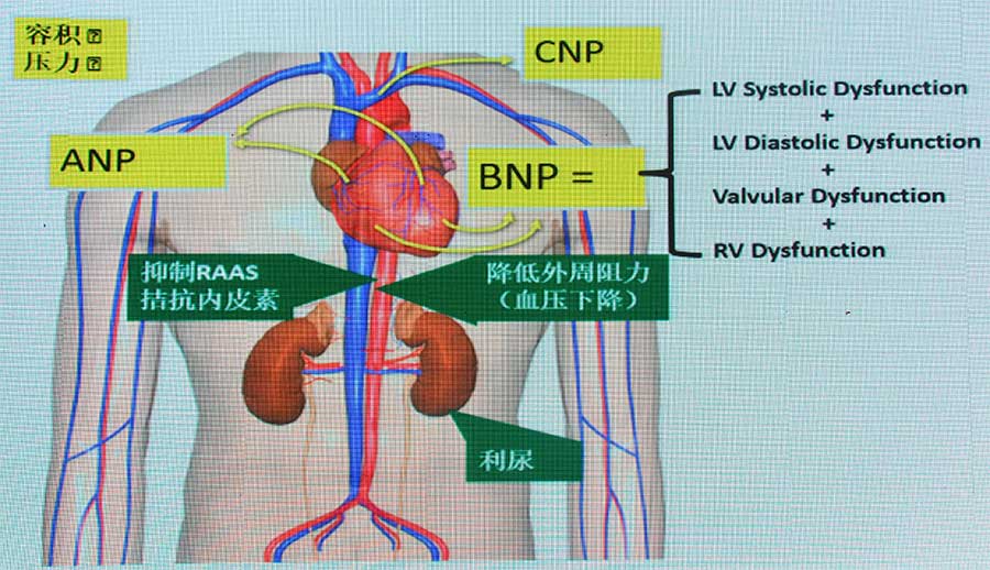 张宇辉教授:BNP和NT-proBNP在心力衰竭诊断