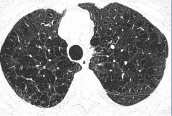 不同类型肺气肿的病理特点和影像特征