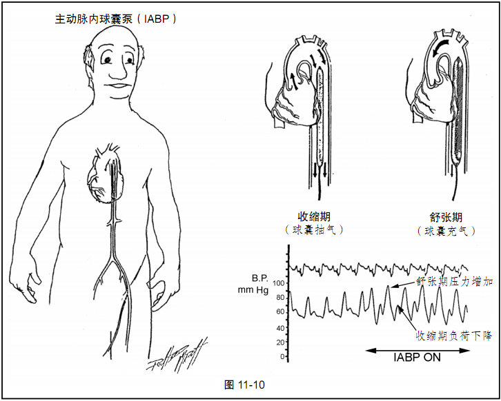 不稳定型心绞痛如何识别和管理