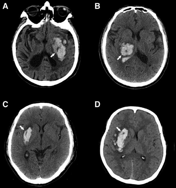 神经影像:ct上出现这些征象,警惕脑血肿扩大