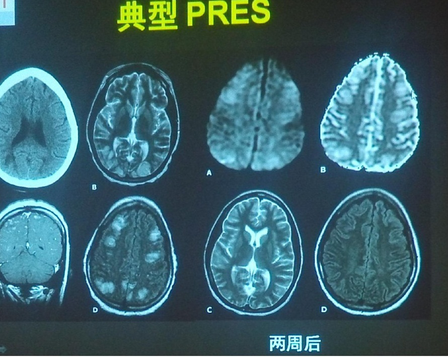 图文解读:可逆性胼胝体压部病变综合征知多少?