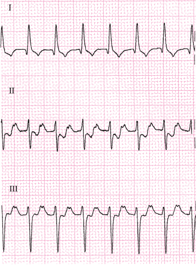 一文总结:预激综合征的心电图特点和诊治