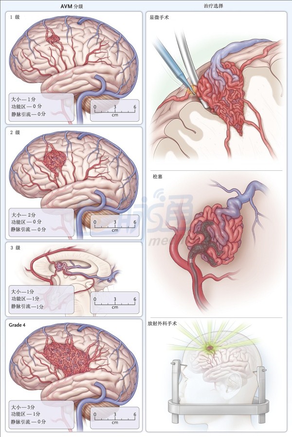 NEJM综述:脑动静脉畸形