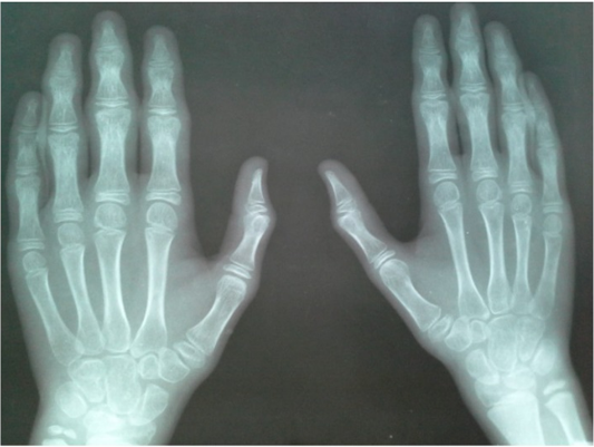 易与幼年特发性关节炎混淆的这个疾病,你了解