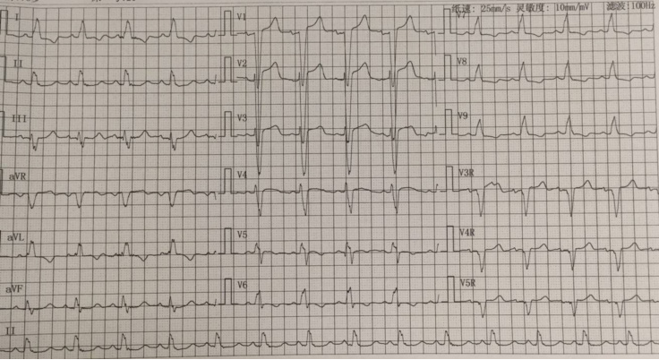 心电图表现为左束支传导阻滞,我该如何诊断?